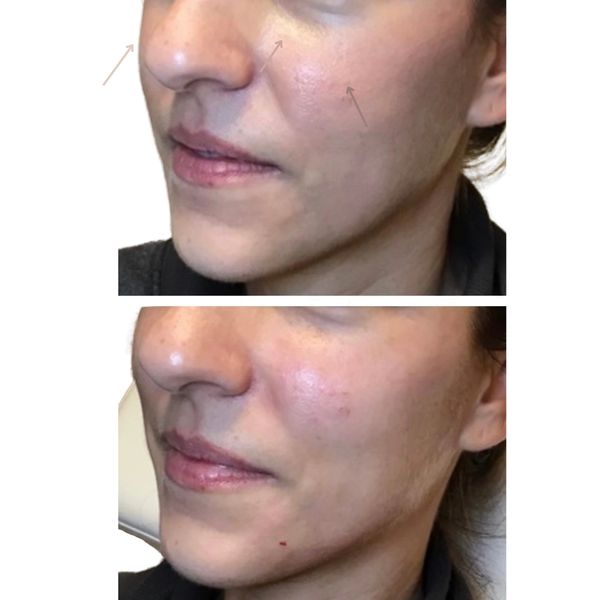 facial-balancing before and after result