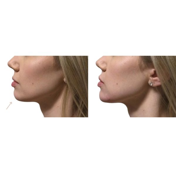 facial-balancing before and after result