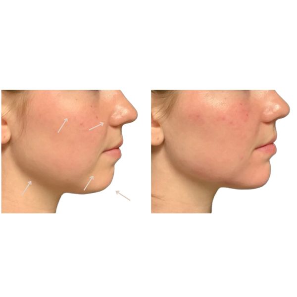 facial-balancing before and after result
