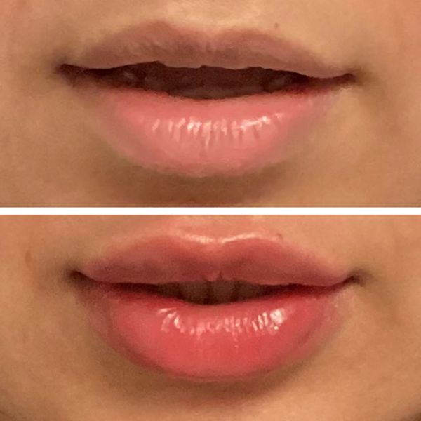 lip-filler before and after result