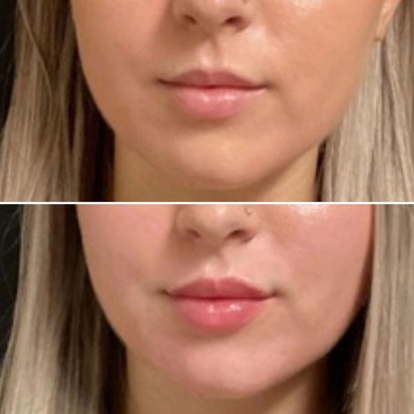 lip-filler before and after result