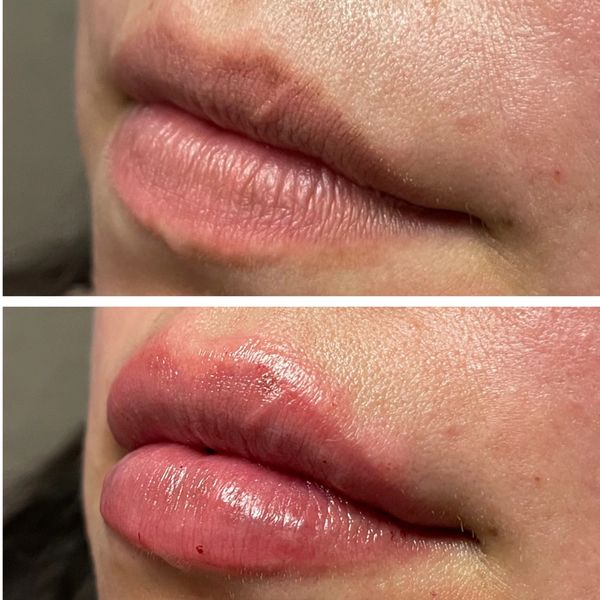 lip-filler before and after result