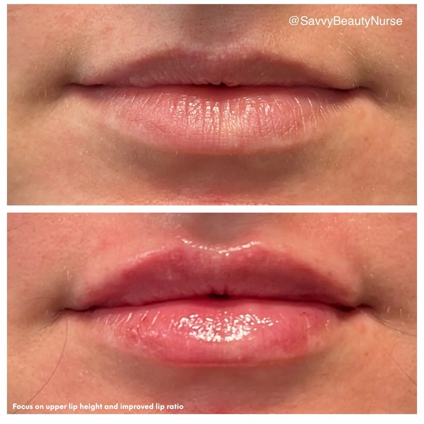 lip-filler before and after result