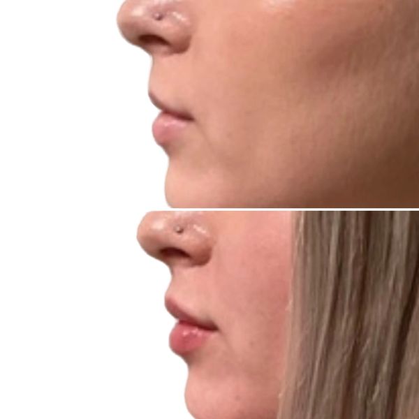 lip-filler before and after result