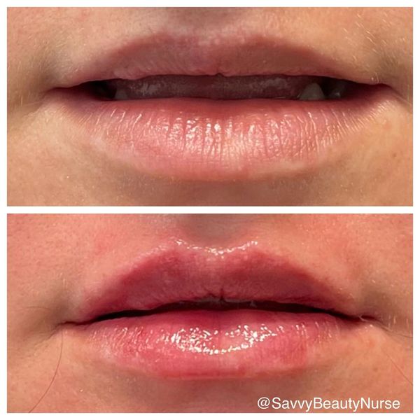 lip-filler before and after result