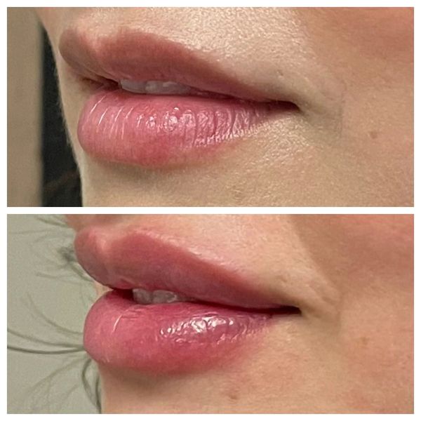 lip-filler before and after result