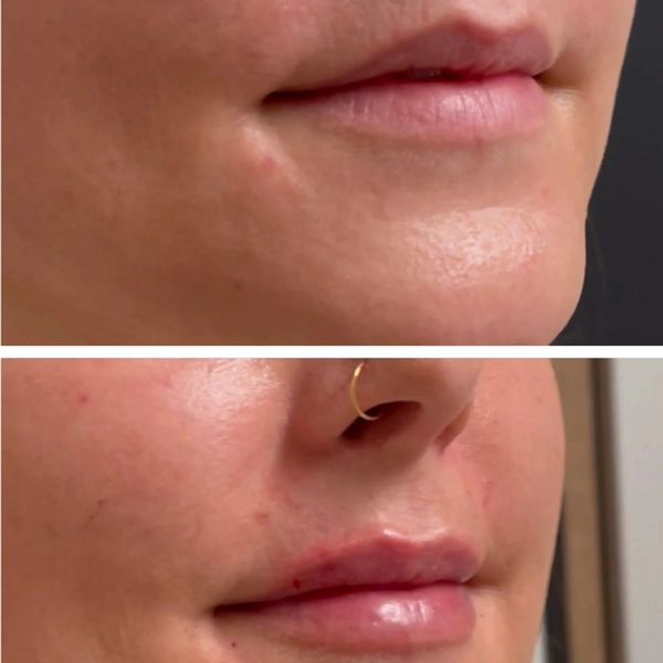 lip-filler before and after result