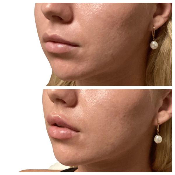 lip-filler before and after result