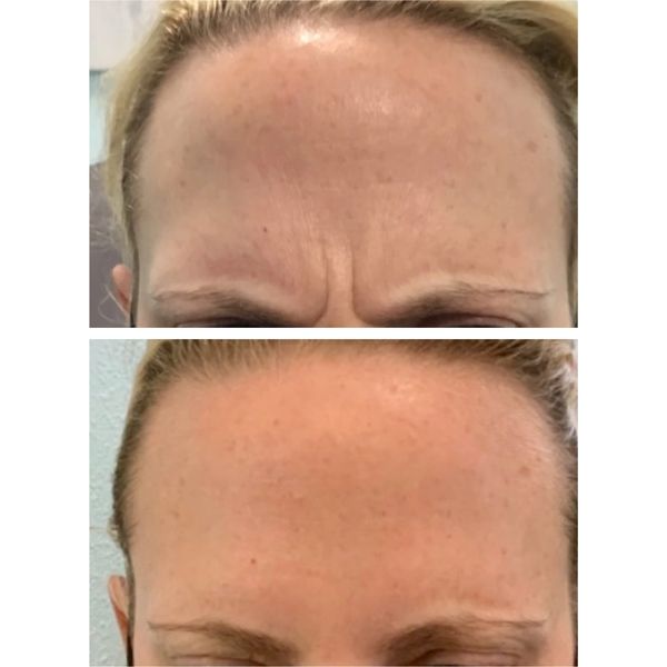 wrinkle-relaxers before and after result
