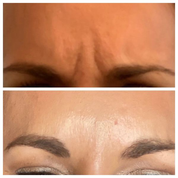 wrinkle-relaxers before and after result
