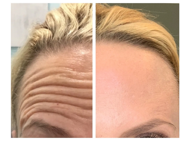 wrinkle-relaxers before and after result