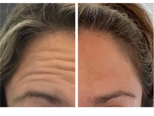 wrinkle-relaxers before and after result
