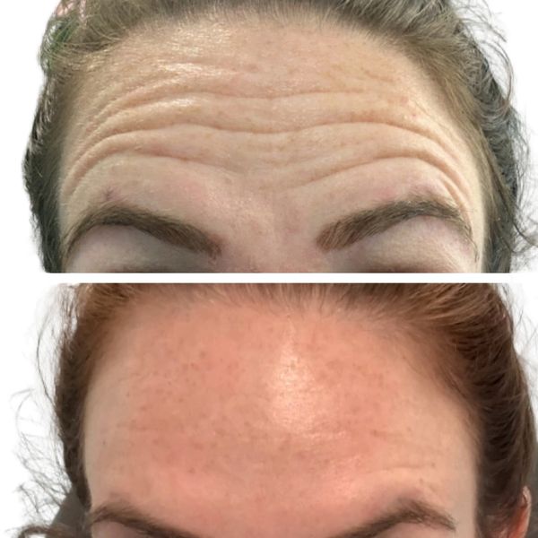 wrinkle-relaxers before and after result
