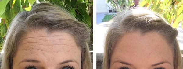 wrinkle-relaxers before and after result