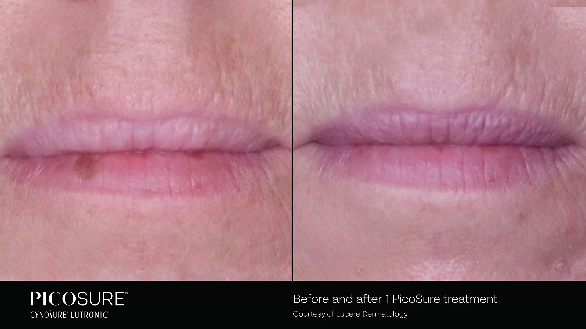 picosure before and after result