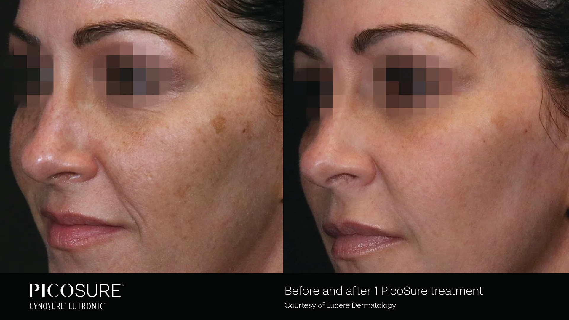 picosure before and after result