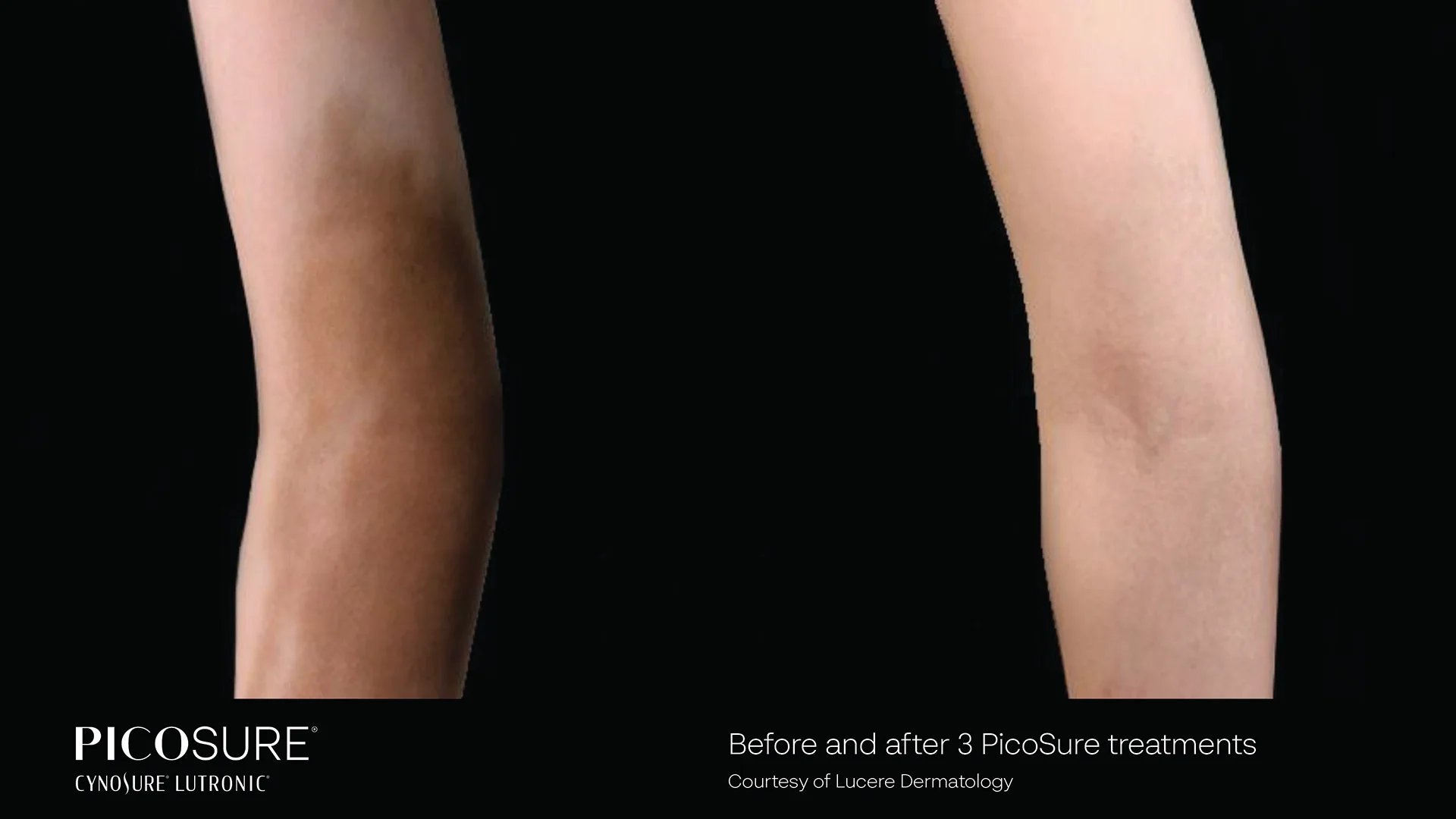 picosure before and after result