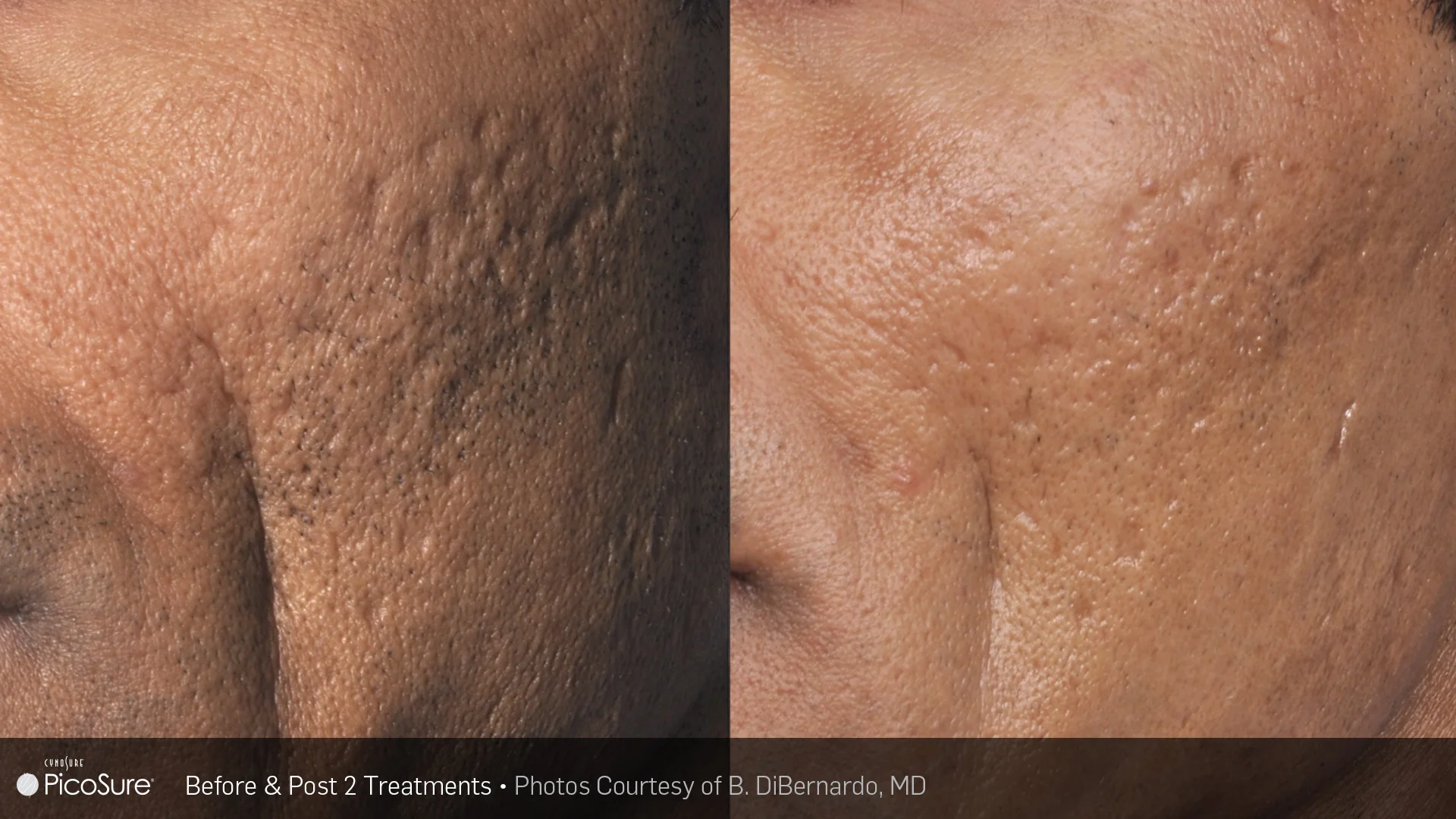 picosure before and after result