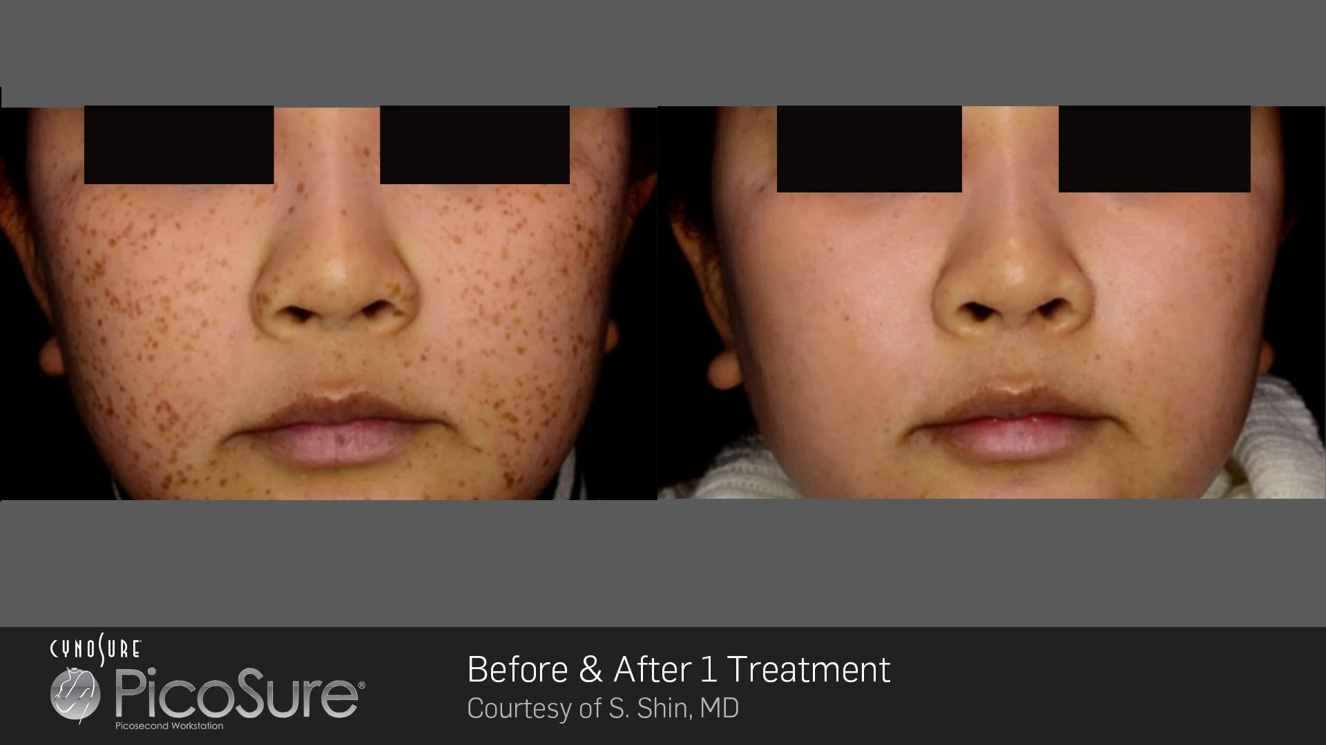 picosure before and after result