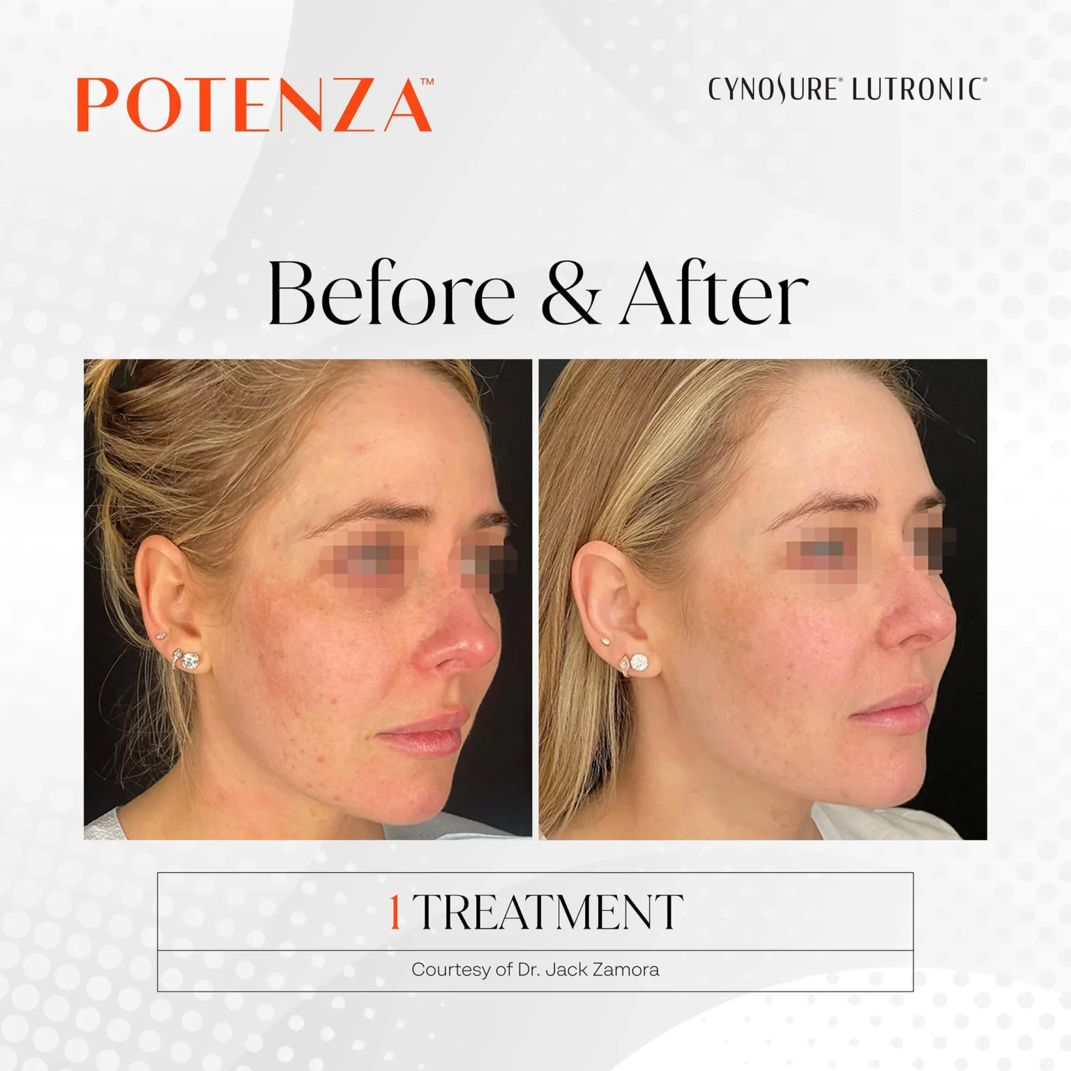 potenza before and after result