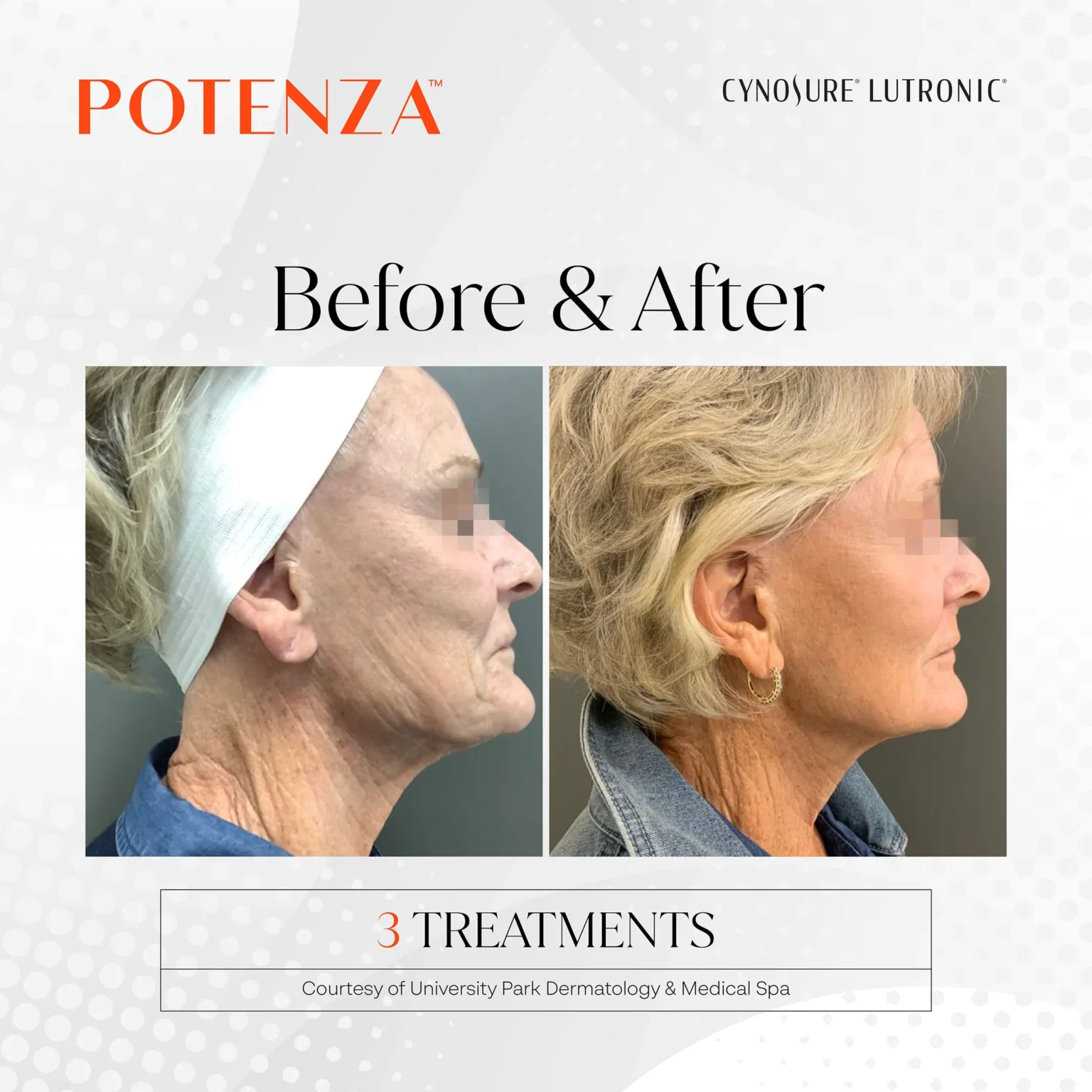 potenza before and after result