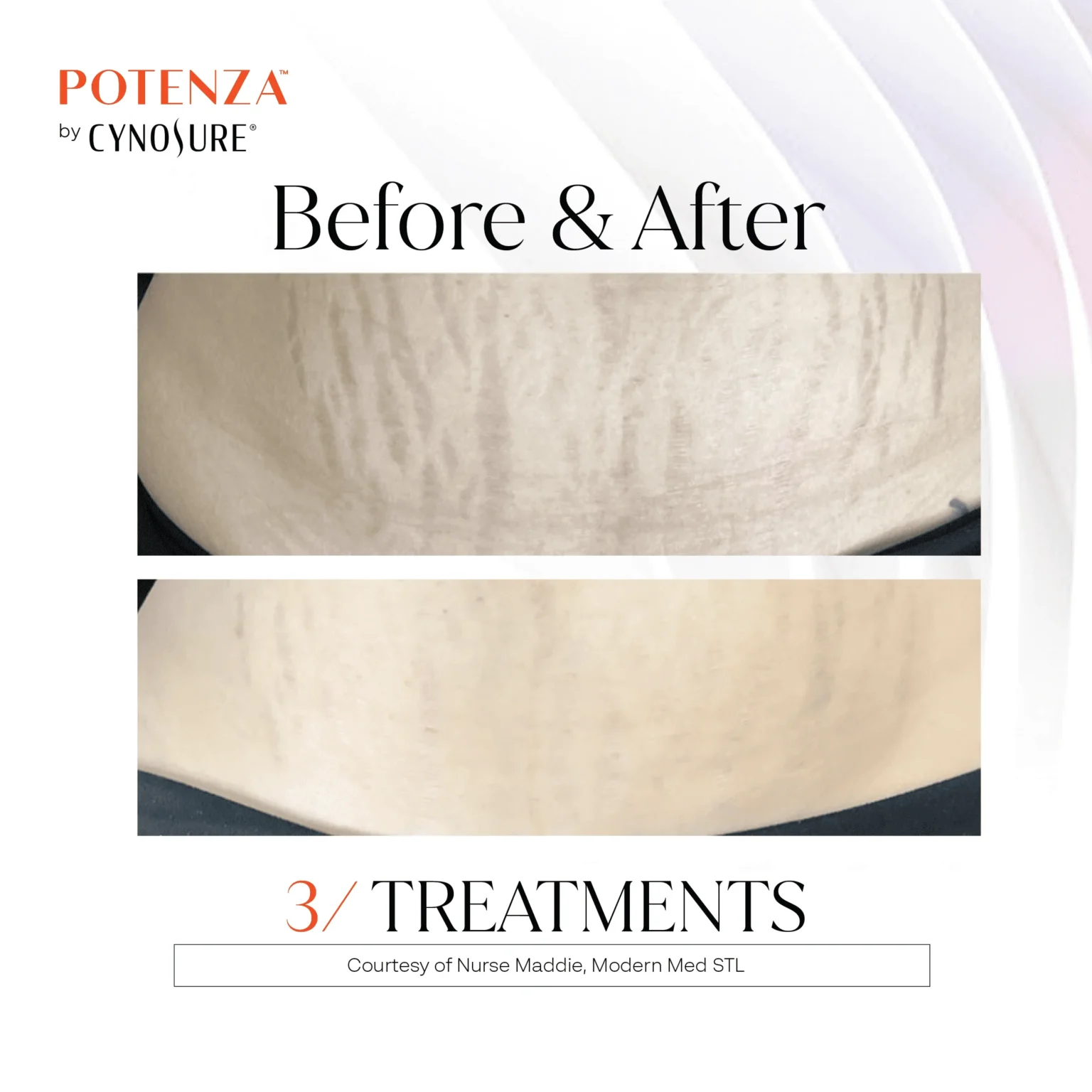 potenza before and after result