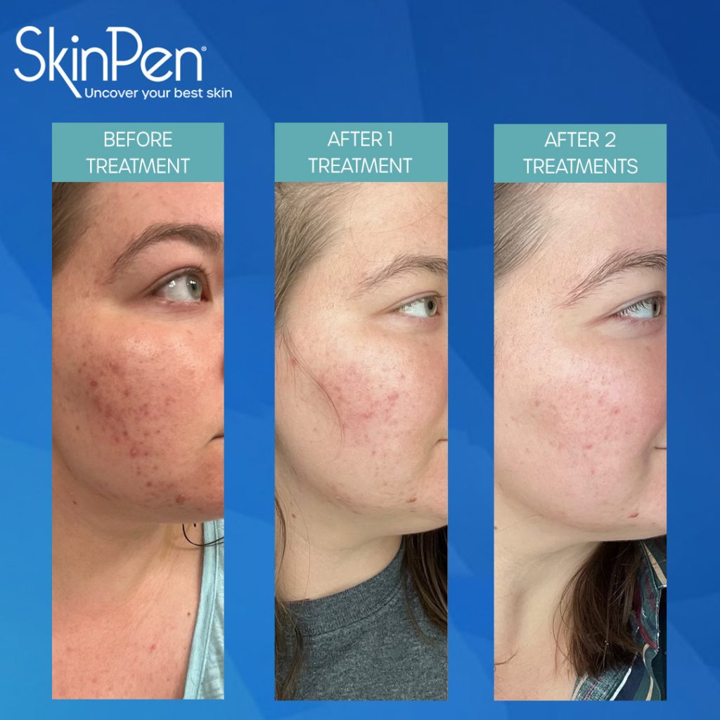 SkinPen Microneedling