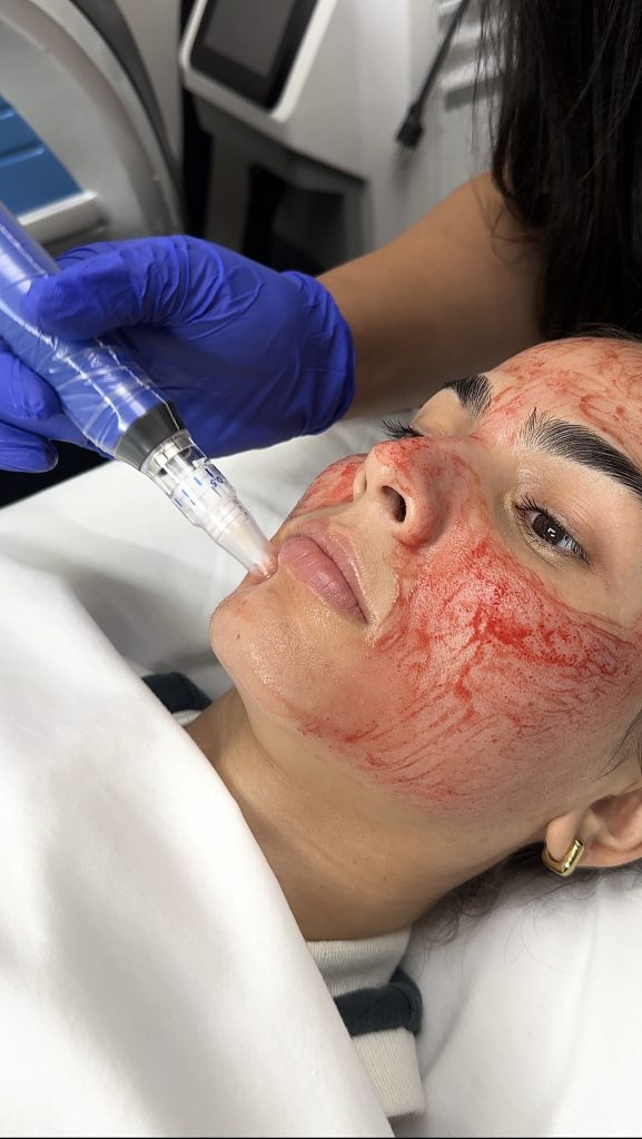 SkinPen Microneedling