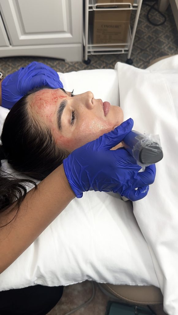 How PRP Facials and Injections works